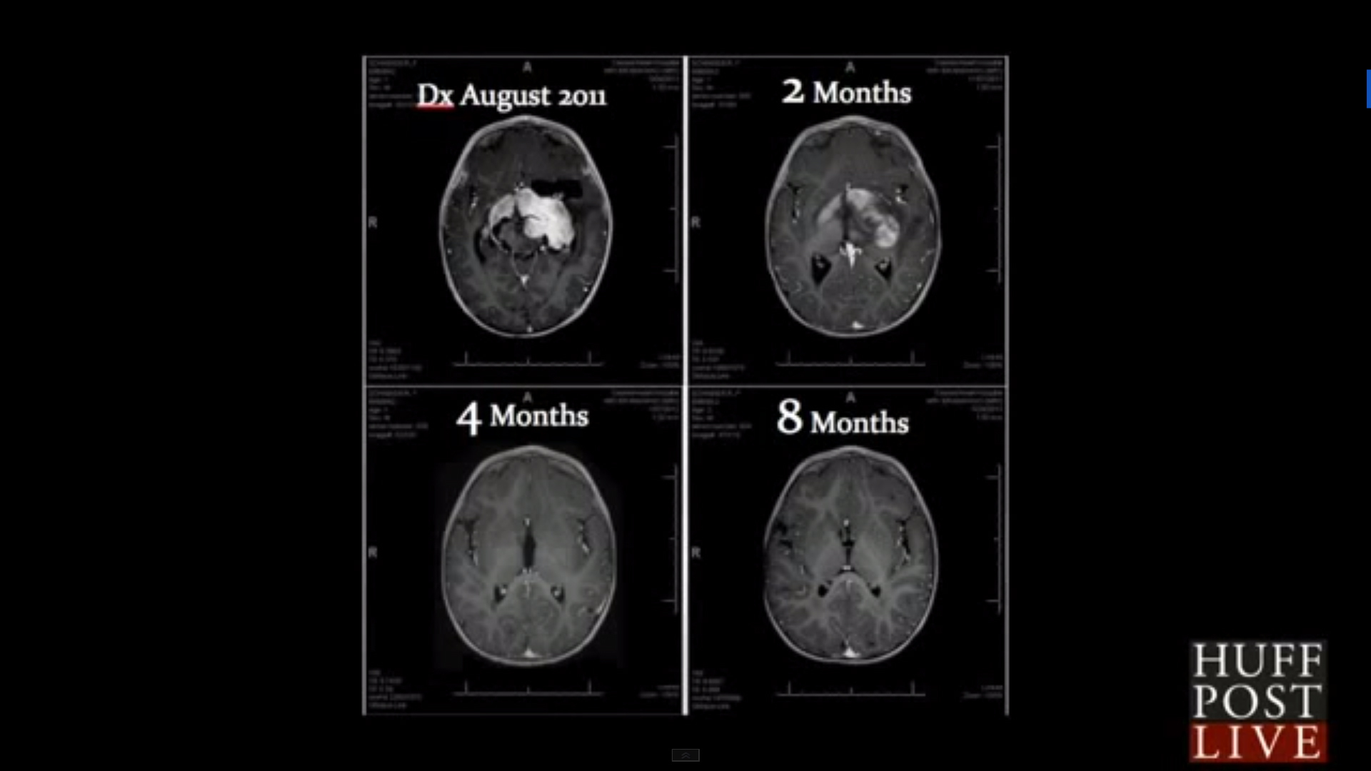 cannabis-oil-cbd-brain-tumor-treatmenty